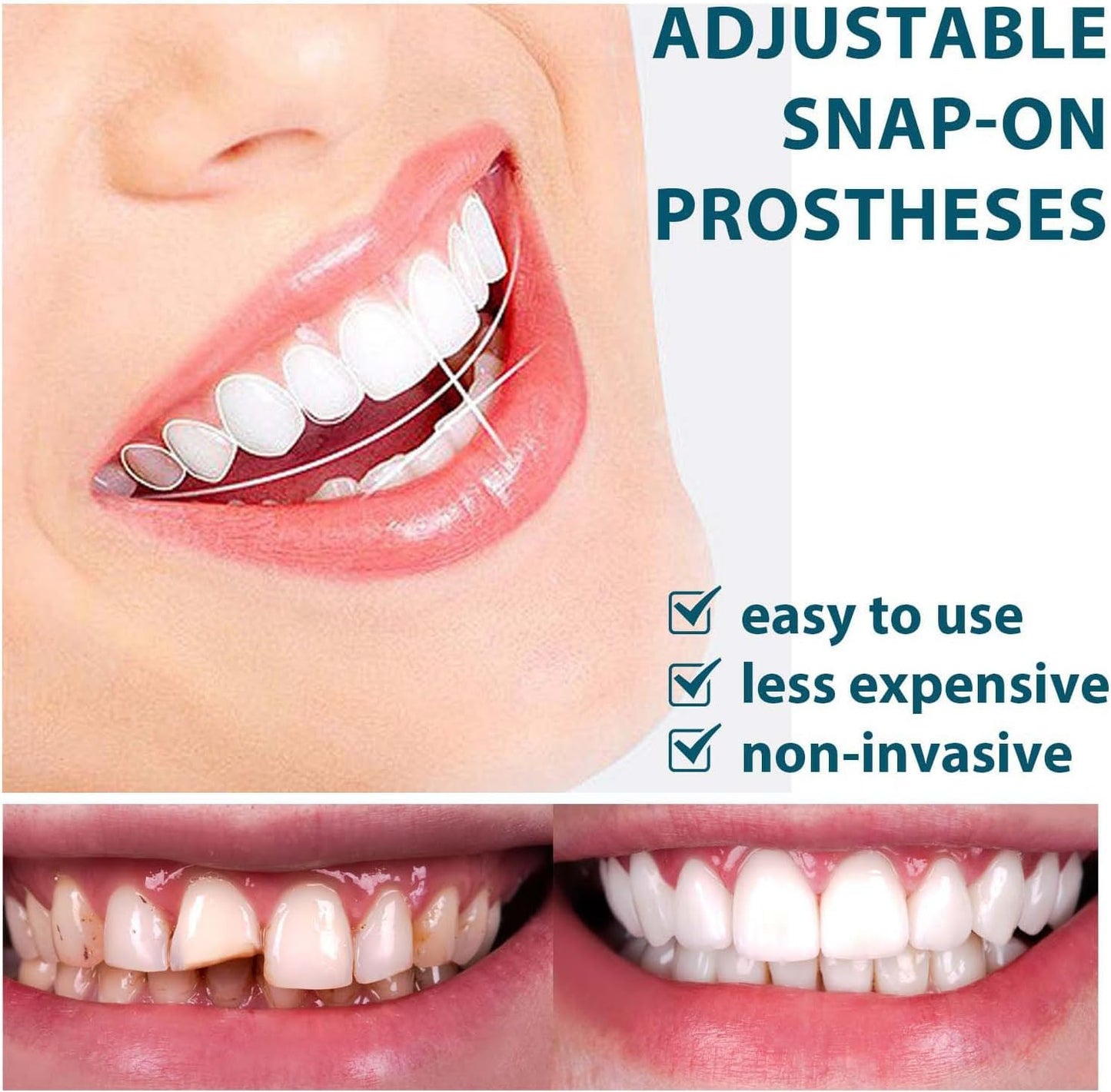 Snap On Smile Braces Teeth Kit For Men & Women | Buy 1 Get 1 Free